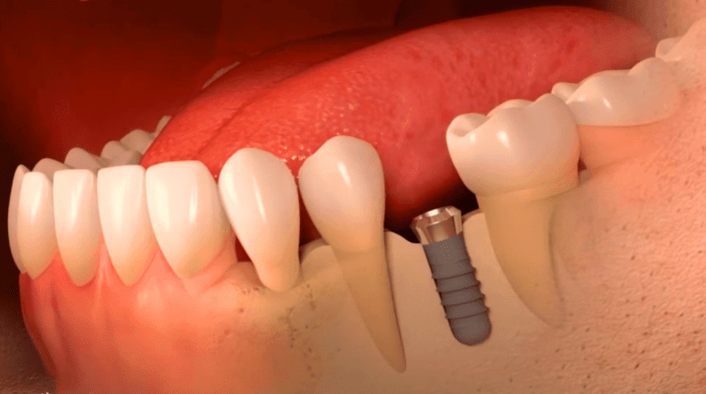 implantologie dentaire